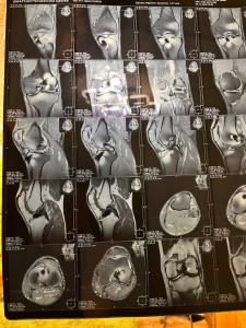 Разрыв мениска 3 степени