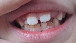 Может ли быть флюороз ?