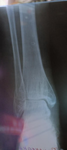 Перелом? (Добавлены фото)