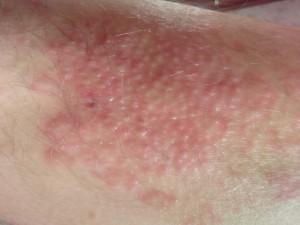 Аллергические реакции