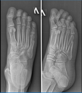 Перелом 5 плюсневой кости