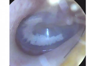 Состояние барабанных перепонок у обучающегося с минимальными расстройствами слуховых функций.