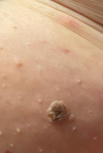 странная родинка