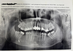 Кривая челюсть