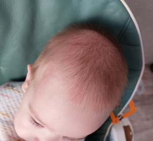 Красные пятна на голове