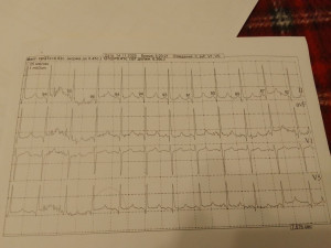 Интервал QTc на холтере эпизод удлинения