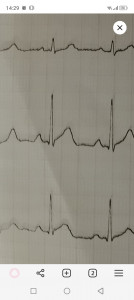 Расшифровка анализа крови и ЭКГ