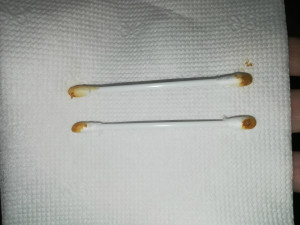 Колющая боль в ухе