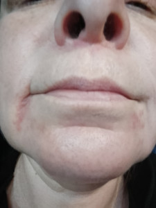 Высыпание в области носа и подбородка.