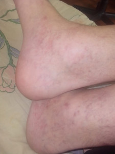 Хроническая венозная недостаточность