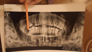 перекрестный прикус