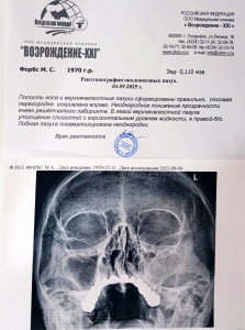 Простреливающая боль как будто прорвет перепонку, при задевании или надавливании на зуб 28 болезненные ощущения.