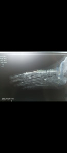 Болит стопа после перелома