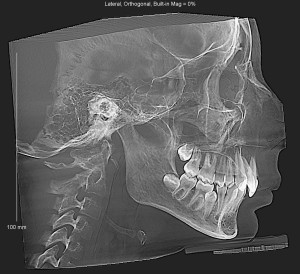 Стоит ли удалять здоровые премоляры?