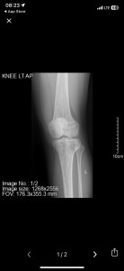 Заключение Очаговое структурное изменение наружного мыщелка левой большеберцовой кости.