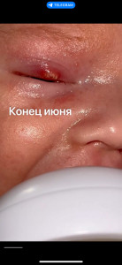 Халязион в 1,5 мес