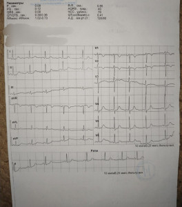 экг,кардиограмма