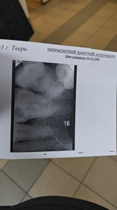 Болит зуб с мышьяком