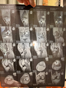 Разрыв мениска 3 степени