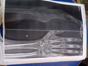 Перелом не срастается