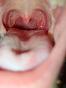 Сильная боль в горле