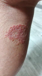 сыпь две недели. немного болит иногда чешится