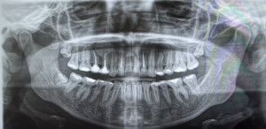 зубы мудрости и киста